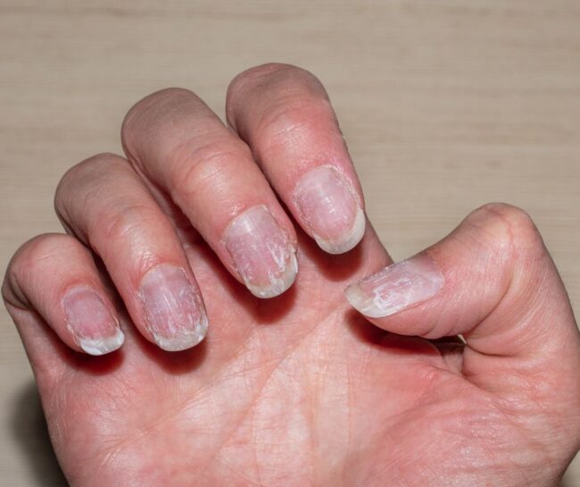 Broken nails 1